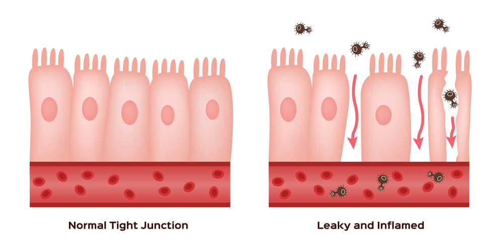aume – leaky gut